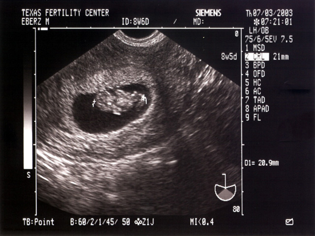 Mojo's Fetus 1